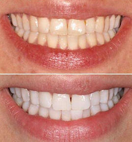 Blanqueador Dental