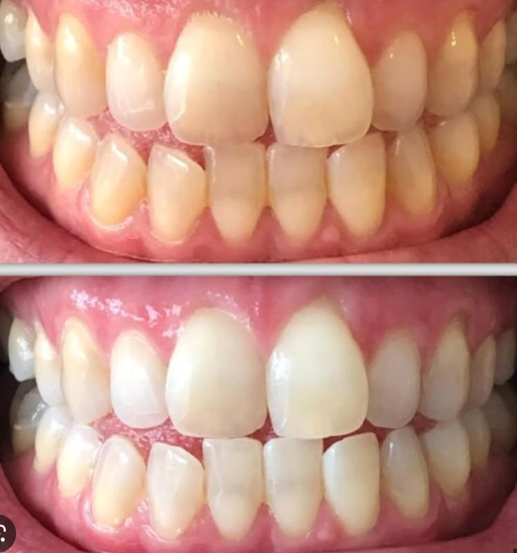 Blanqueador Dental