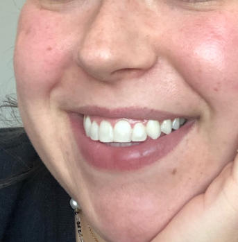 Blanqueador Dental